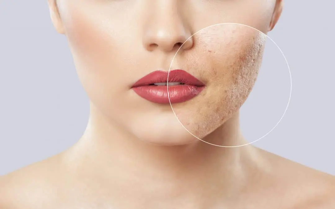 Lady with acne scarring covered by make up