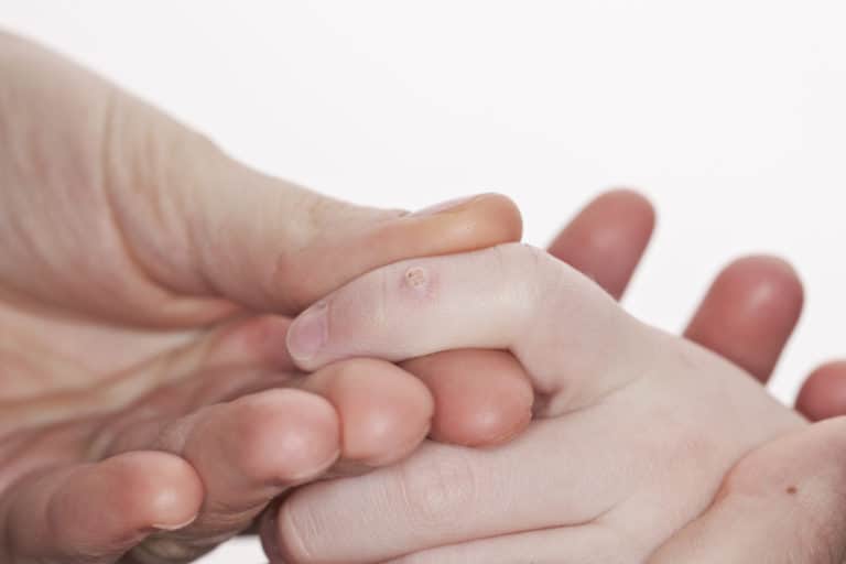 Wart on a child's hand