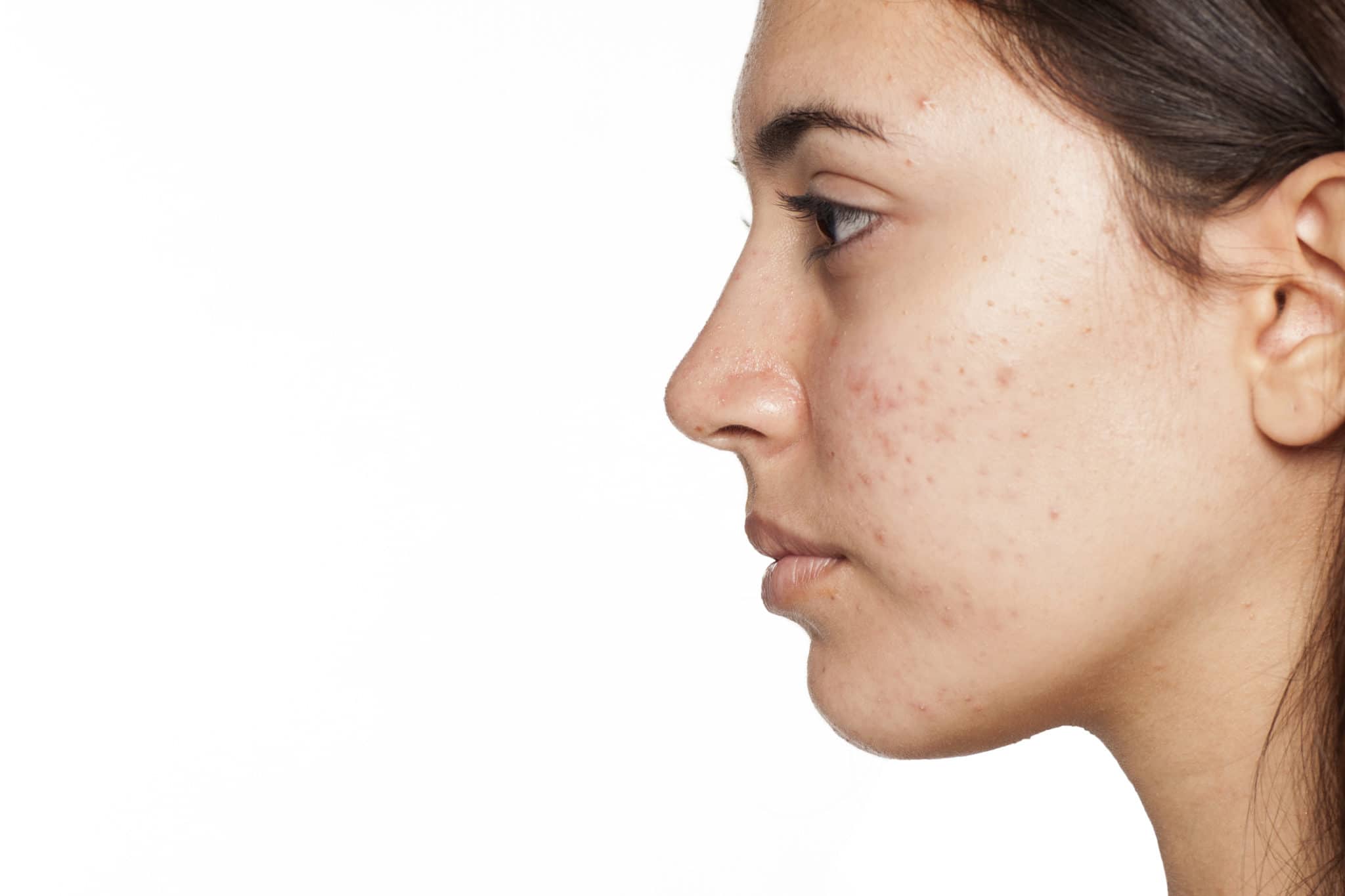 Profile of young girl with acne
