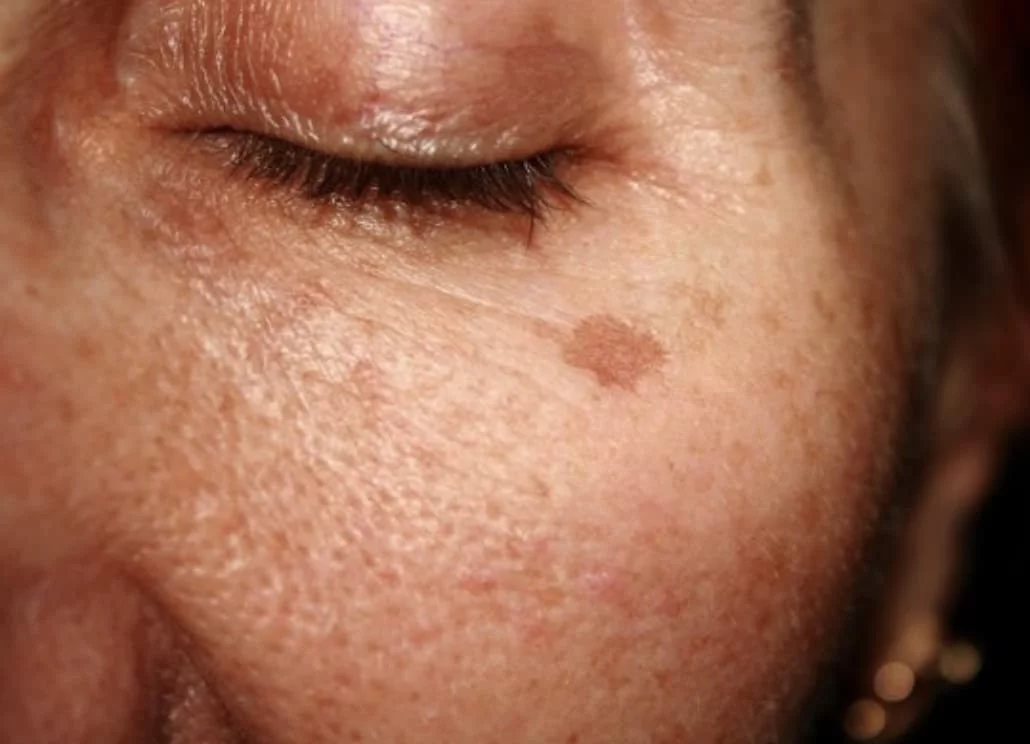 person with Hyperpigmentation or age spot on their face