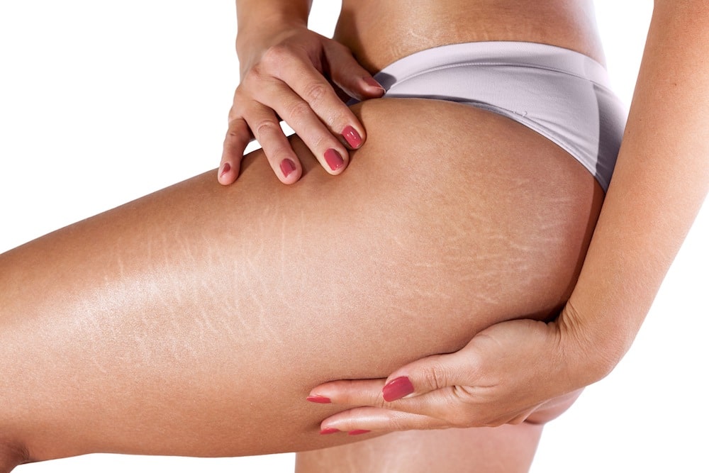 Lady holding leg with stretch marks