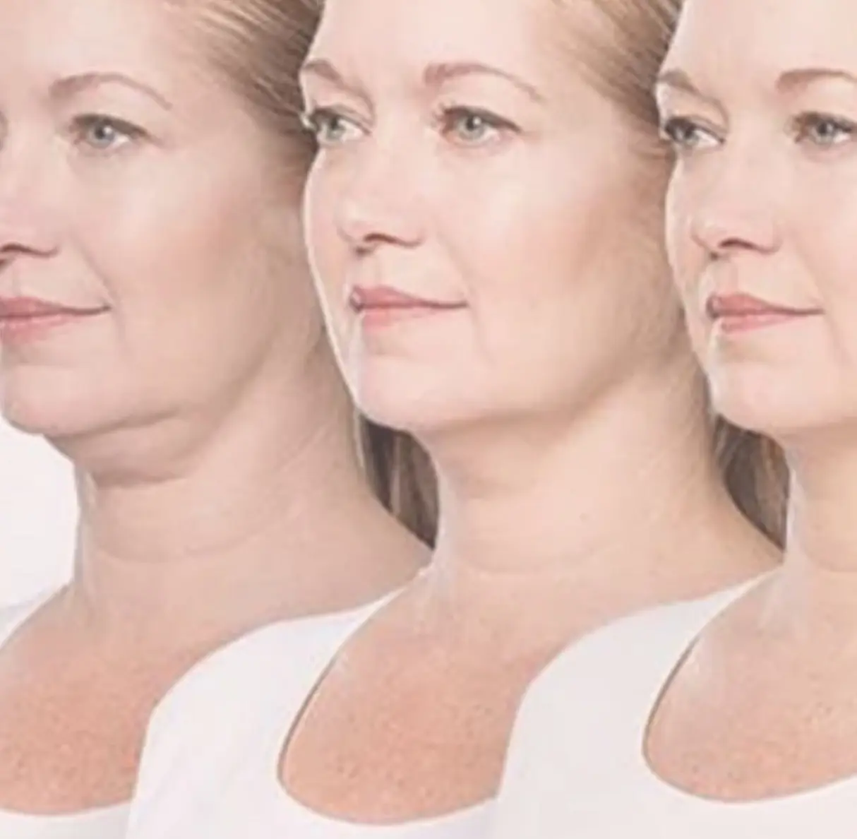 Three ladies with reducing chin size through using fat dissolving injections