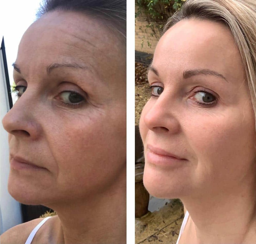 Image showing before and after of someone using advanced aesthetic treatments. Th before shows, pigmented dull skin that is grey and dirty looking and fine lines and static lines lots of volume in the cheeks and thin lips. The after photo shows radiant glowing skin that is rejuvenated refreshed. Vibrant bright volume in the cheek is replaced and lines and wrinkles are diminished.