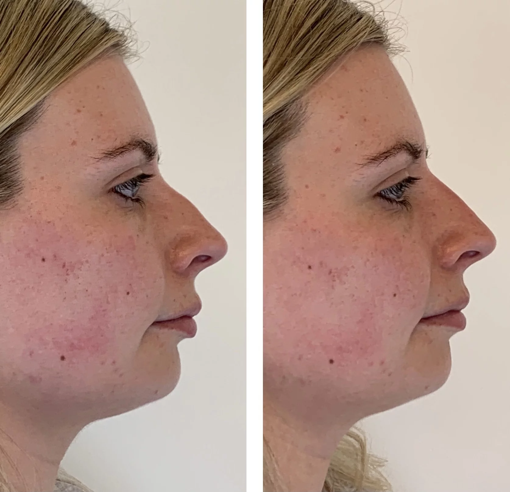 Before and after photo showing non surgical rhinoplasty treatment,