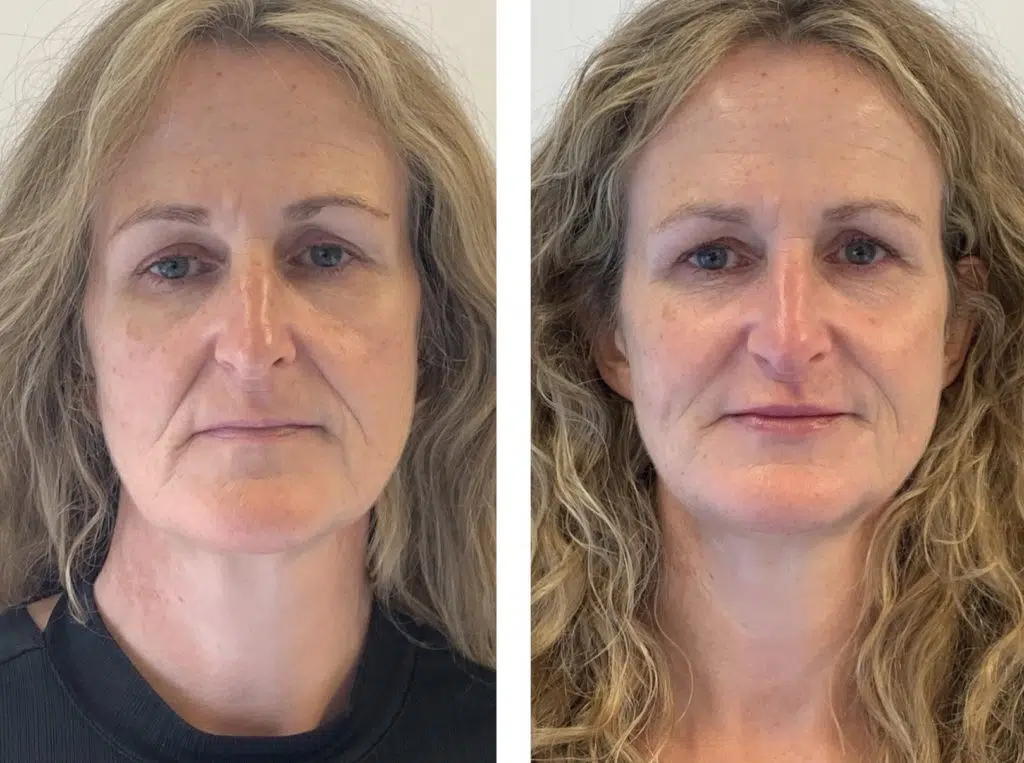 Before and after photos. Alumier skincare and lip and dermal filler treatment.