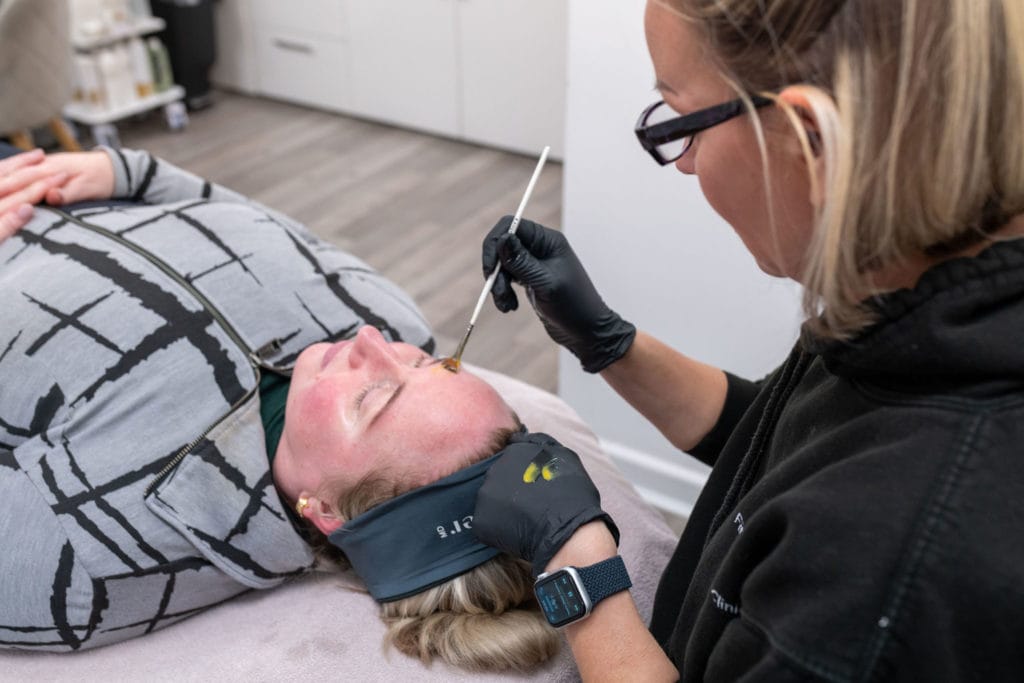 Using the AlumierMD chemical peel solution on my patients face during her treatment.
