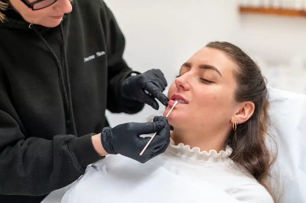 Putting on antiseptic after care after a lip filler dermal filler treatment.