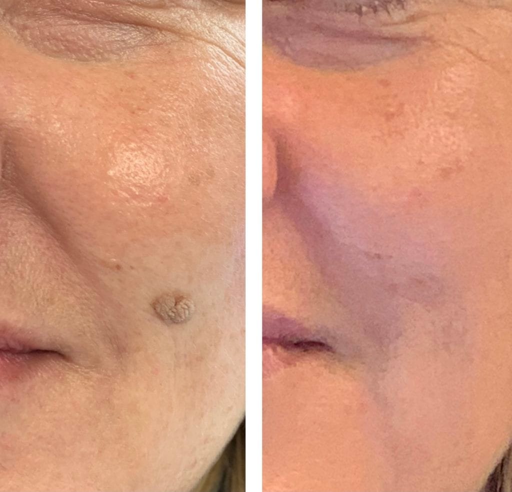 Before and after showing removal of mole using cryotherapy.