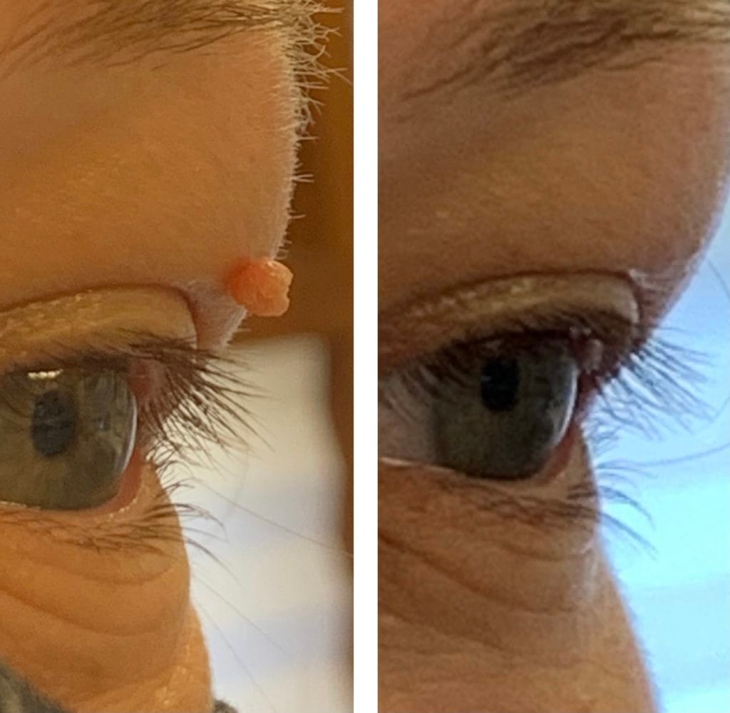 before and after showing Skintag on upper eye lid and its removal