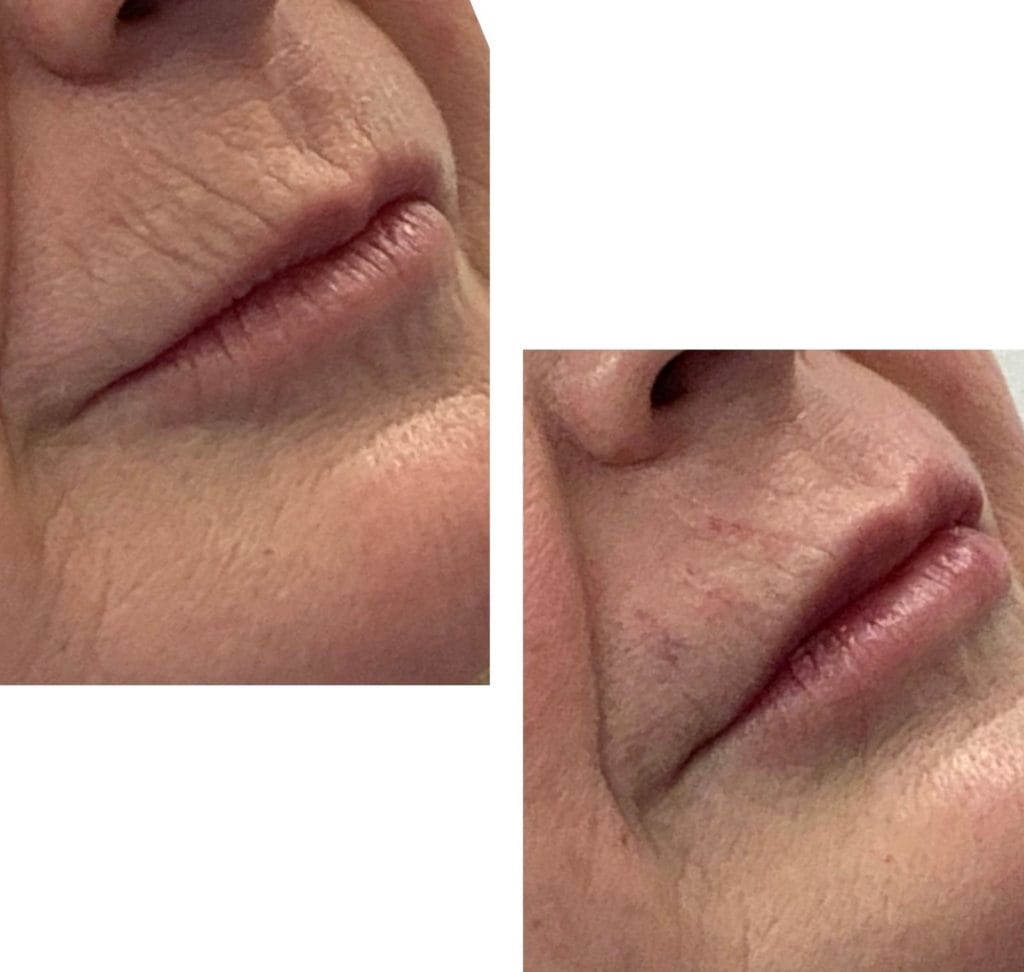 lip filler rejuvenation at Finesse Skin Clinic Gloucestershire