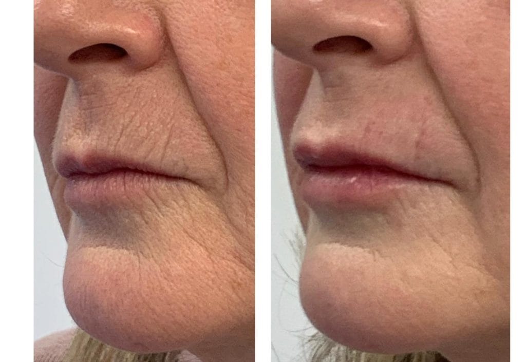 Lip filler results by skilled aesthetics practitioner at Finesse Skin Clinic in Gloucestershire