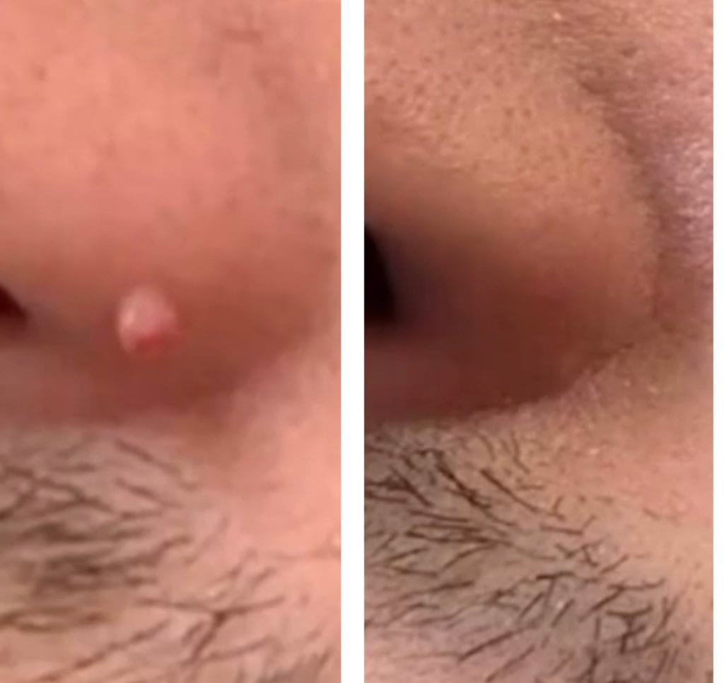 Skin tag removal from nose by Sarah at Finesse Skin Clinic near Stroud