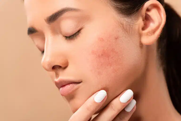 Woman with visible rosacea redness on cheeks and nose