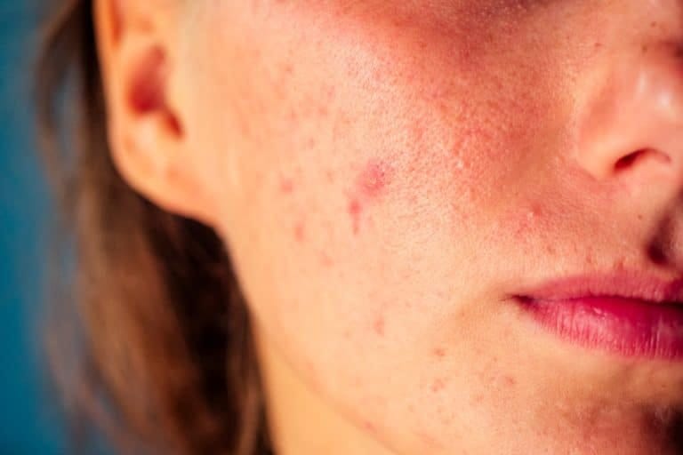 Adult acne and how to treat it