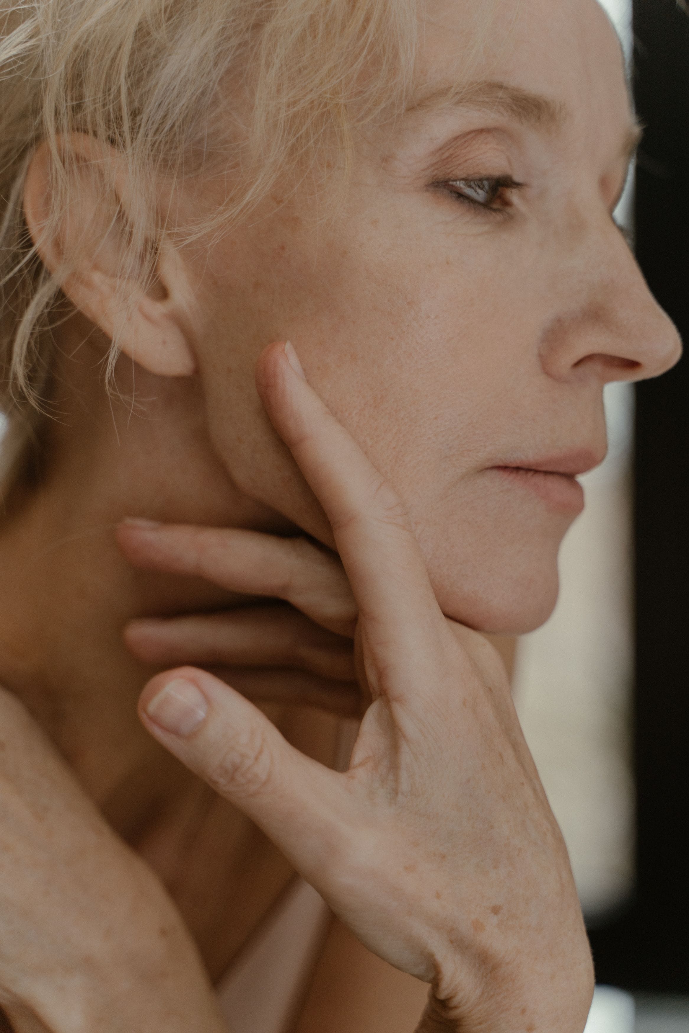 Woman showing facial pigmentation and sun damage before skin treatment