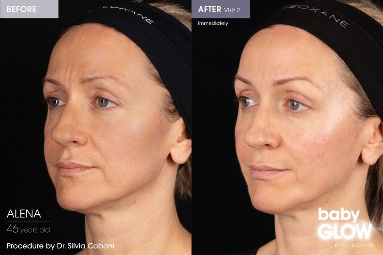 babyGLOWTM results from skin booster treatment