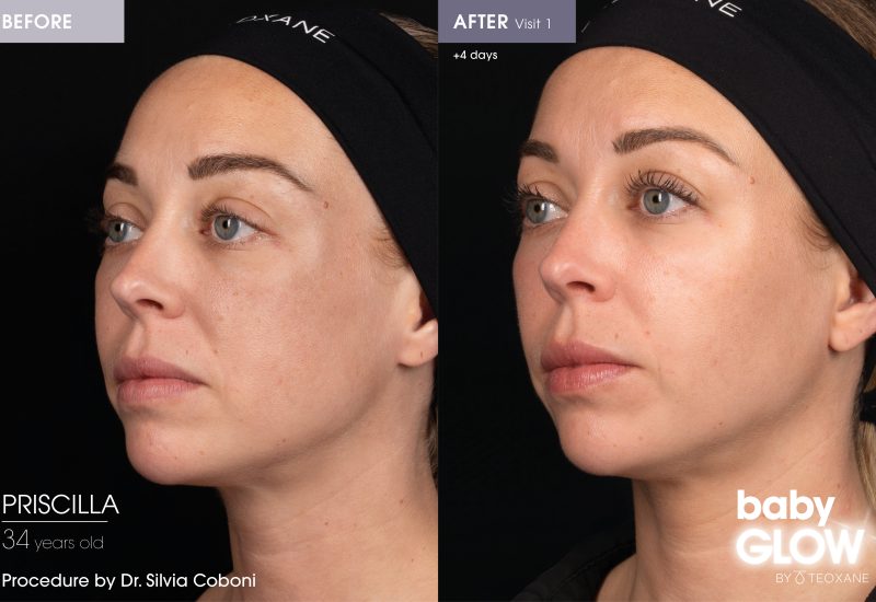babyGLOWTM before and after skin booster treatment