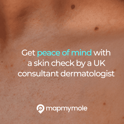 Map my mole - get a skin check by a UK consultant