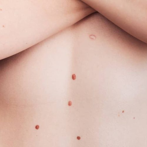 A woman's belly with numerous moles. The effect of the sun on the skin. Skin cancer. The panorama